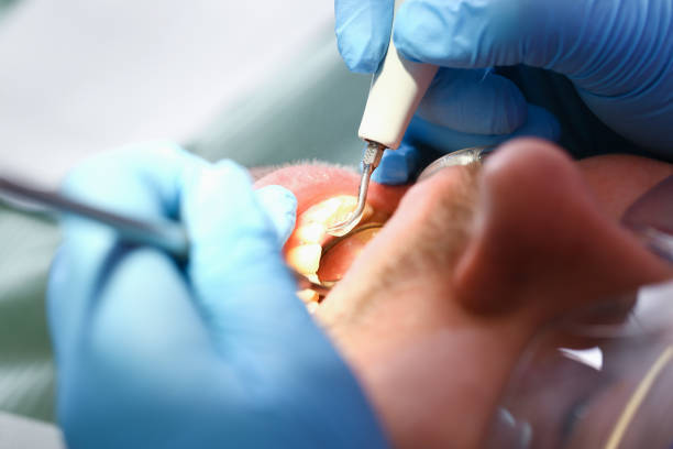 Best Emergency Treatment for Oral Infections in Lake Secession, SC